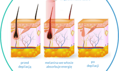 Depilacja laserowa nastolatek